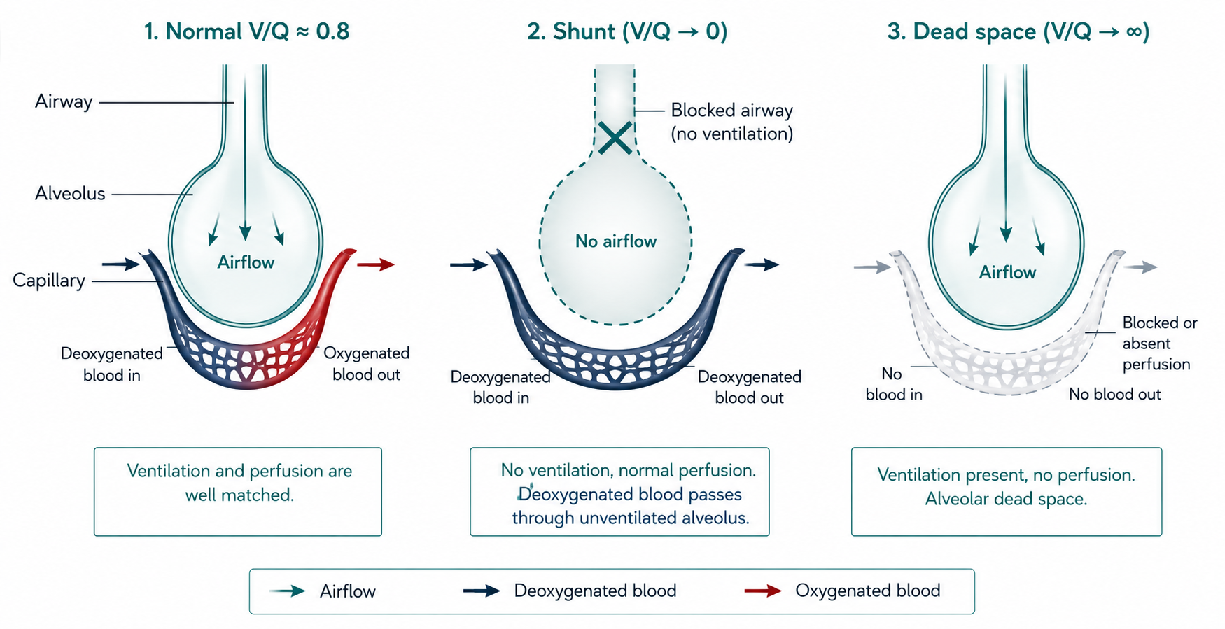 Ventilation&ndash;perfusion mismatch: shunt and dead space